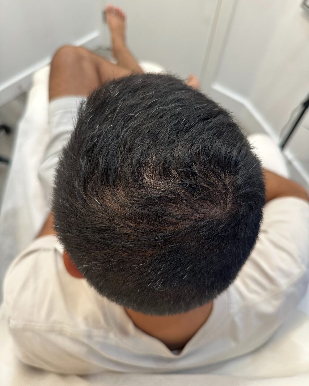 Hair Restoration
