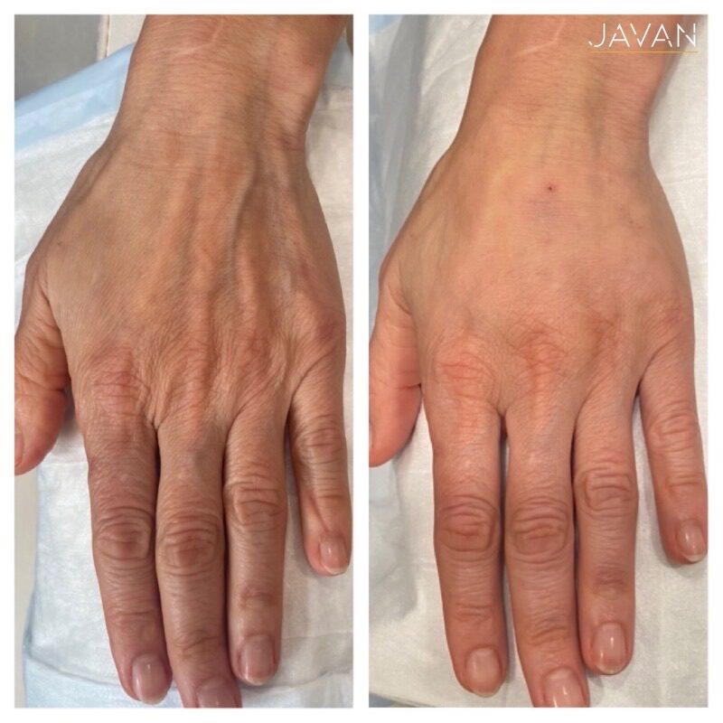 Hand rejuvenation before and after