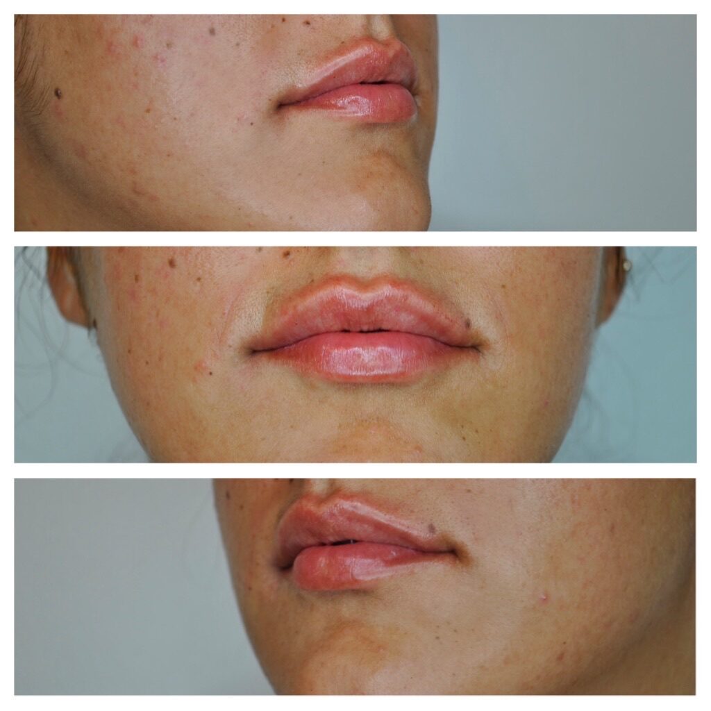 Lip filler enhancement