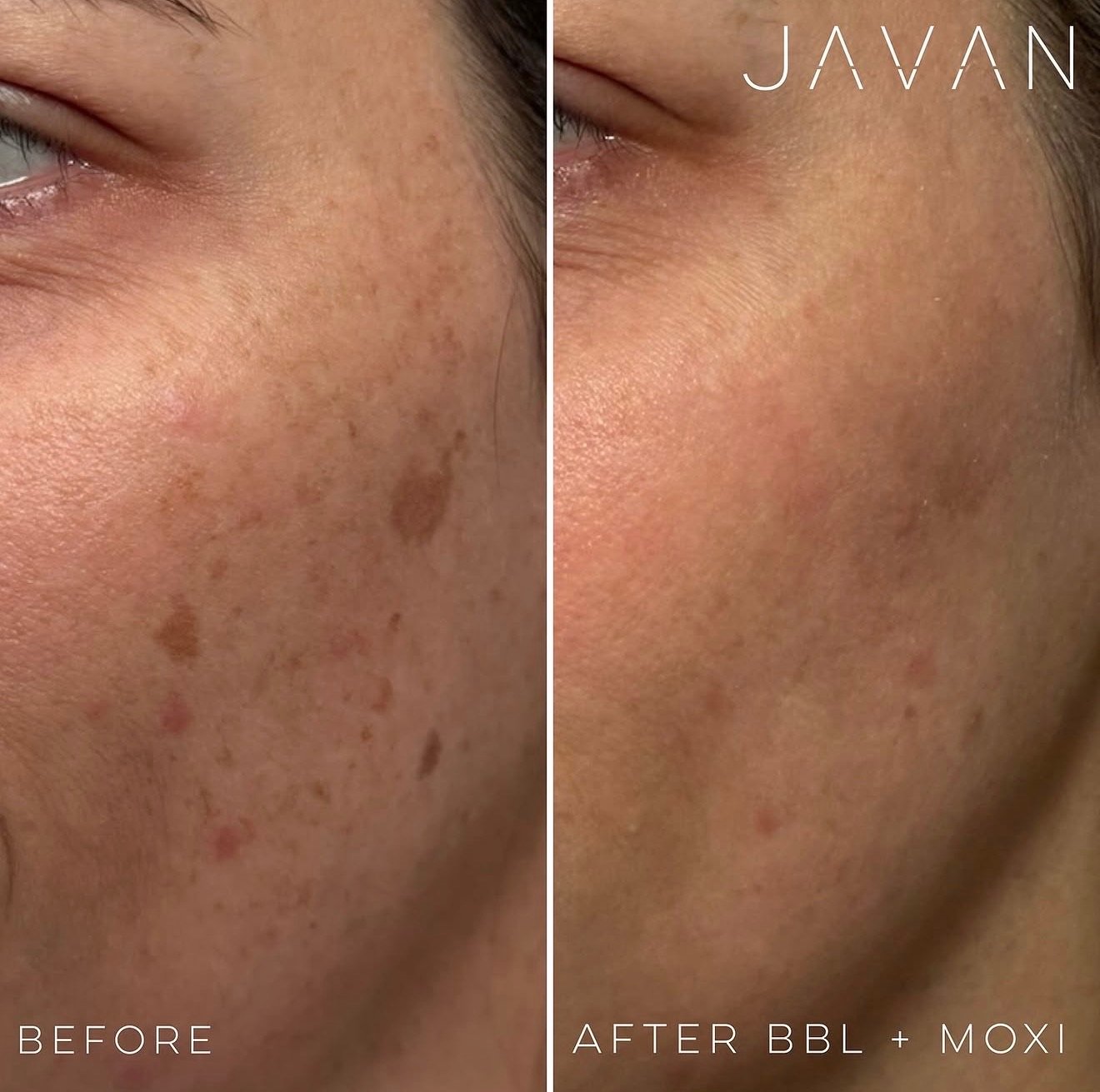 Resurface + Tone (BBL + Moxi)
