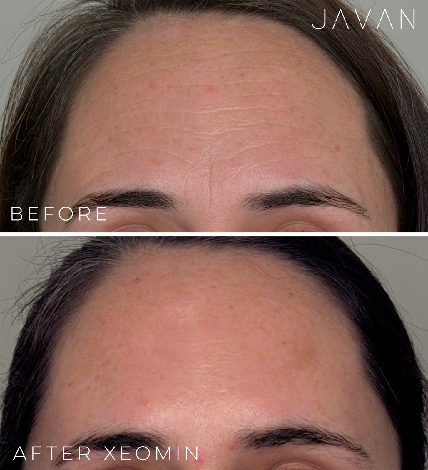 Botox for Hyperhidrosis