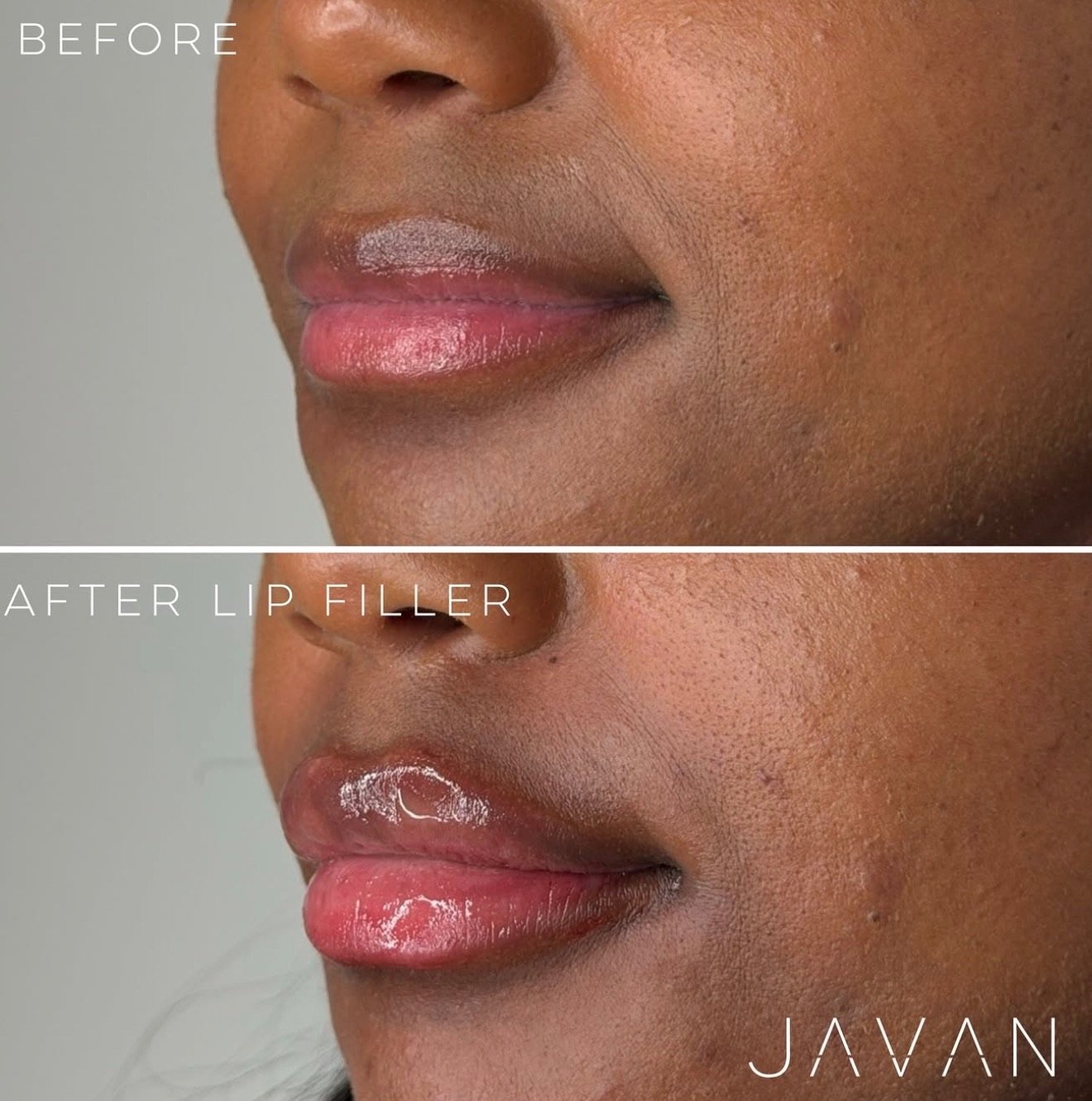 Dermal Fillers
