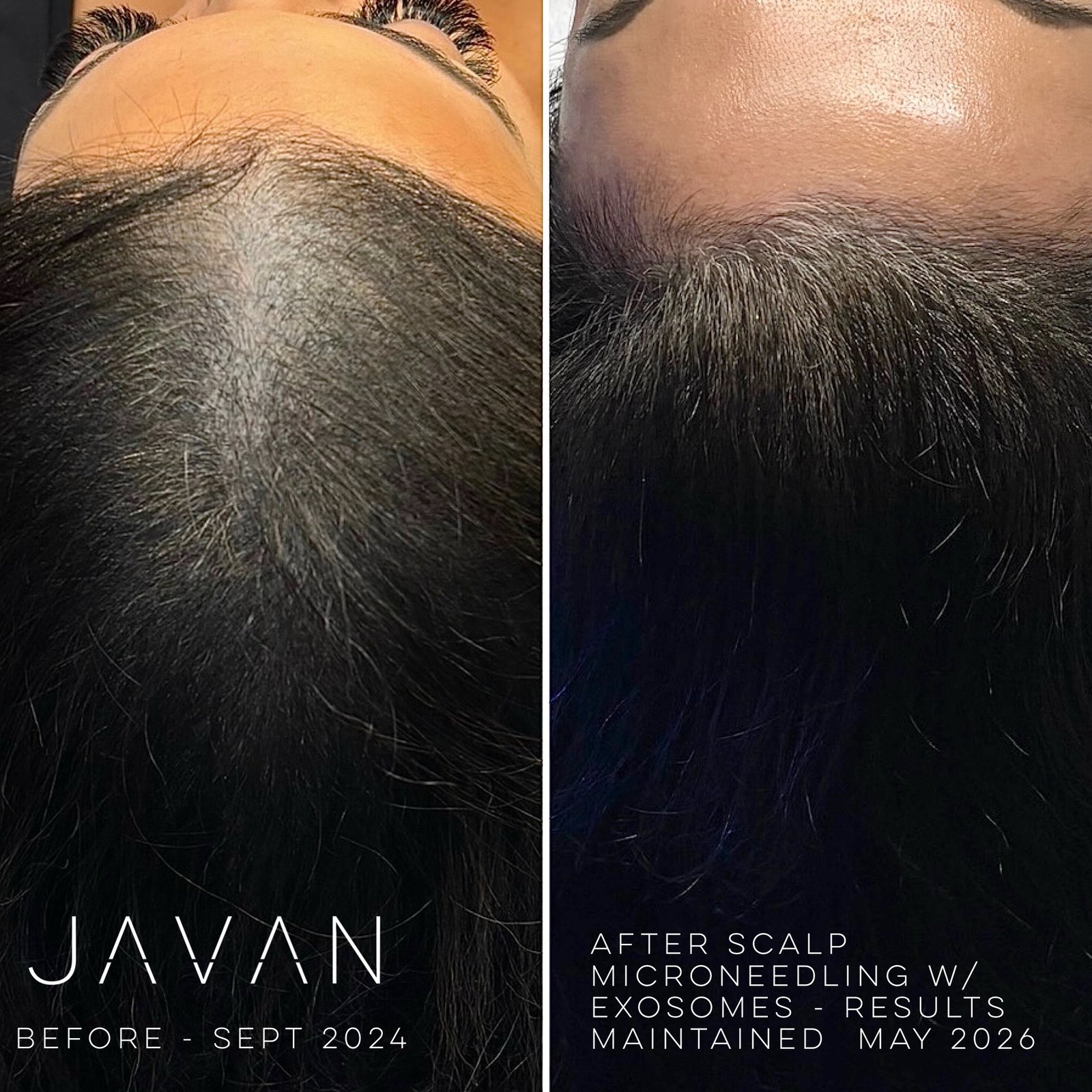 Hair Loss Treatments