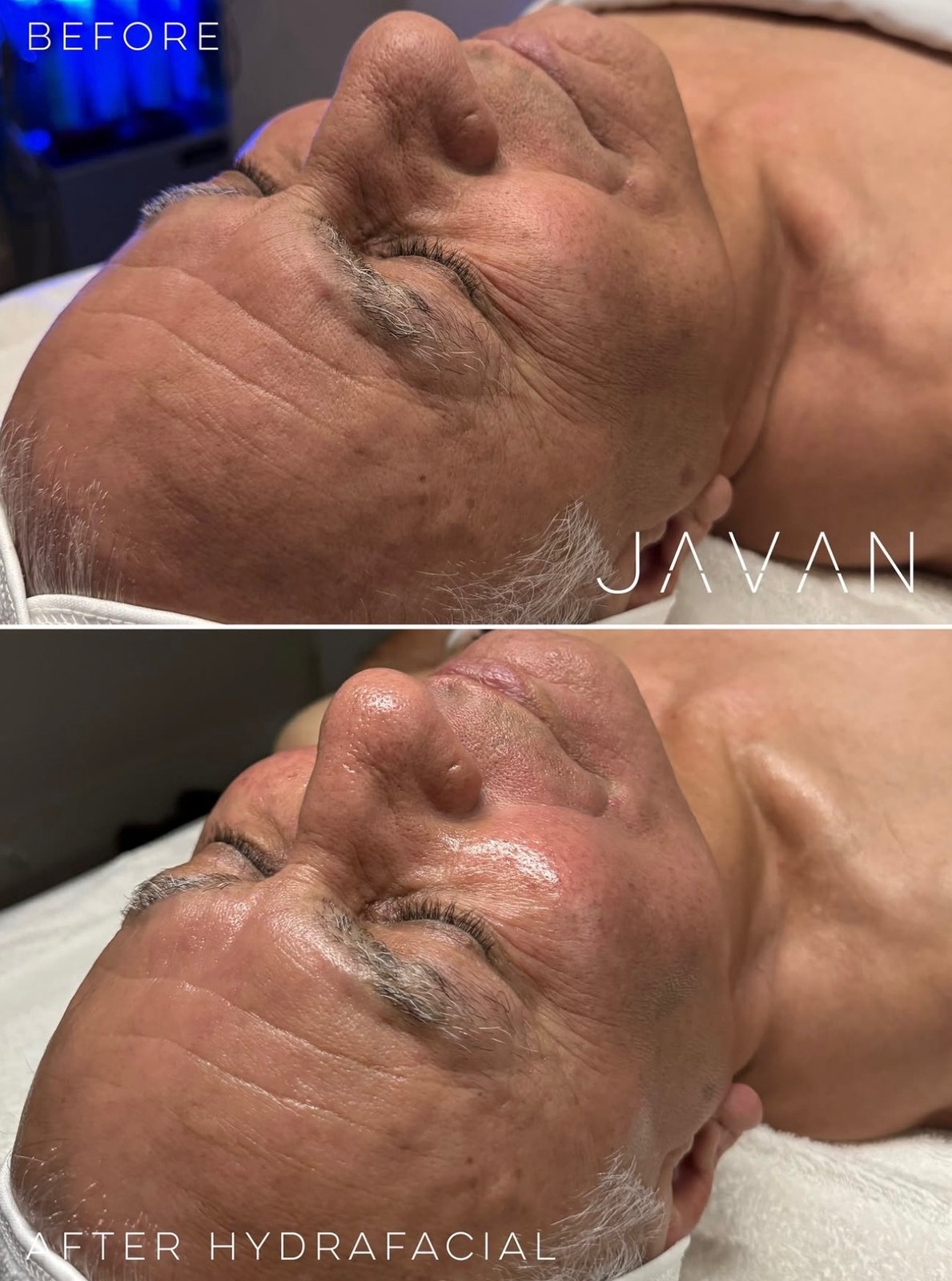 HydraFacial Keravive Scalp Treatment