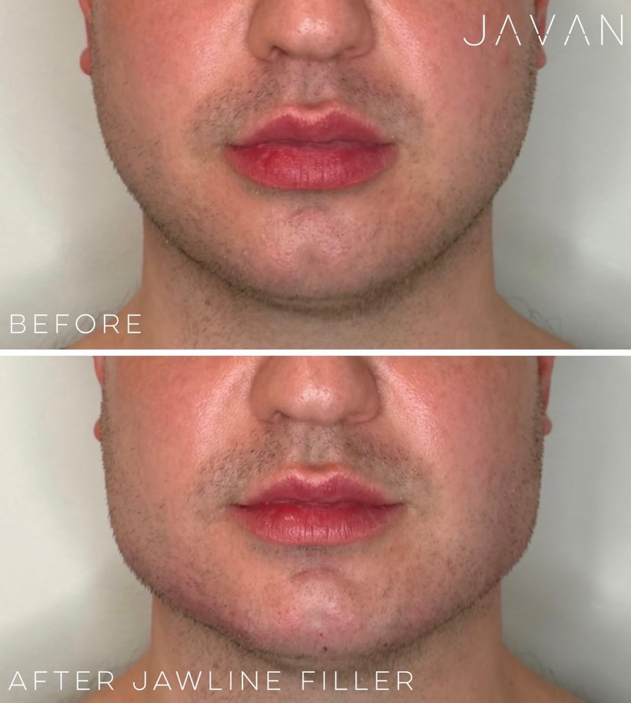 Jawline filler before and after
