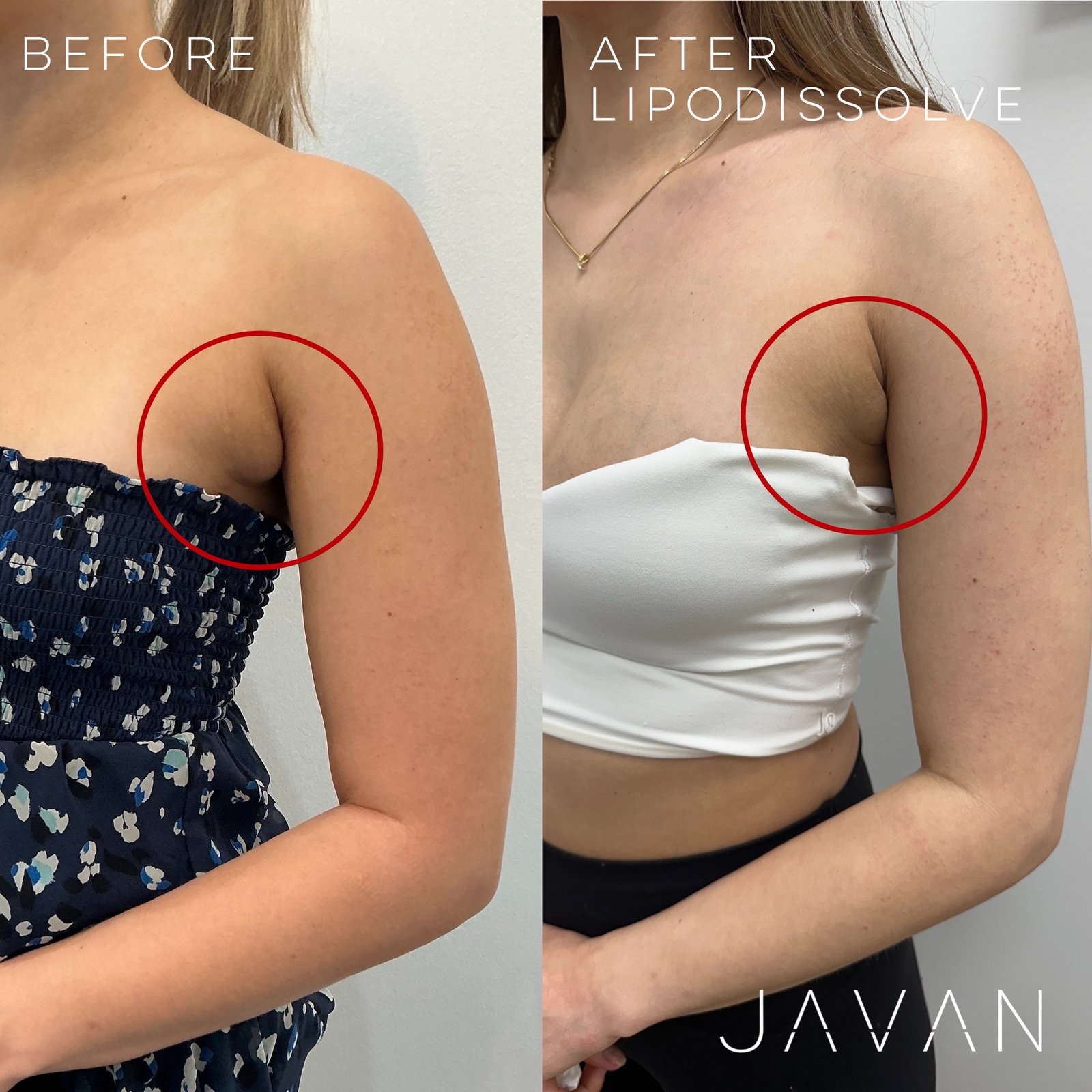 Kybella / Lipodissolve