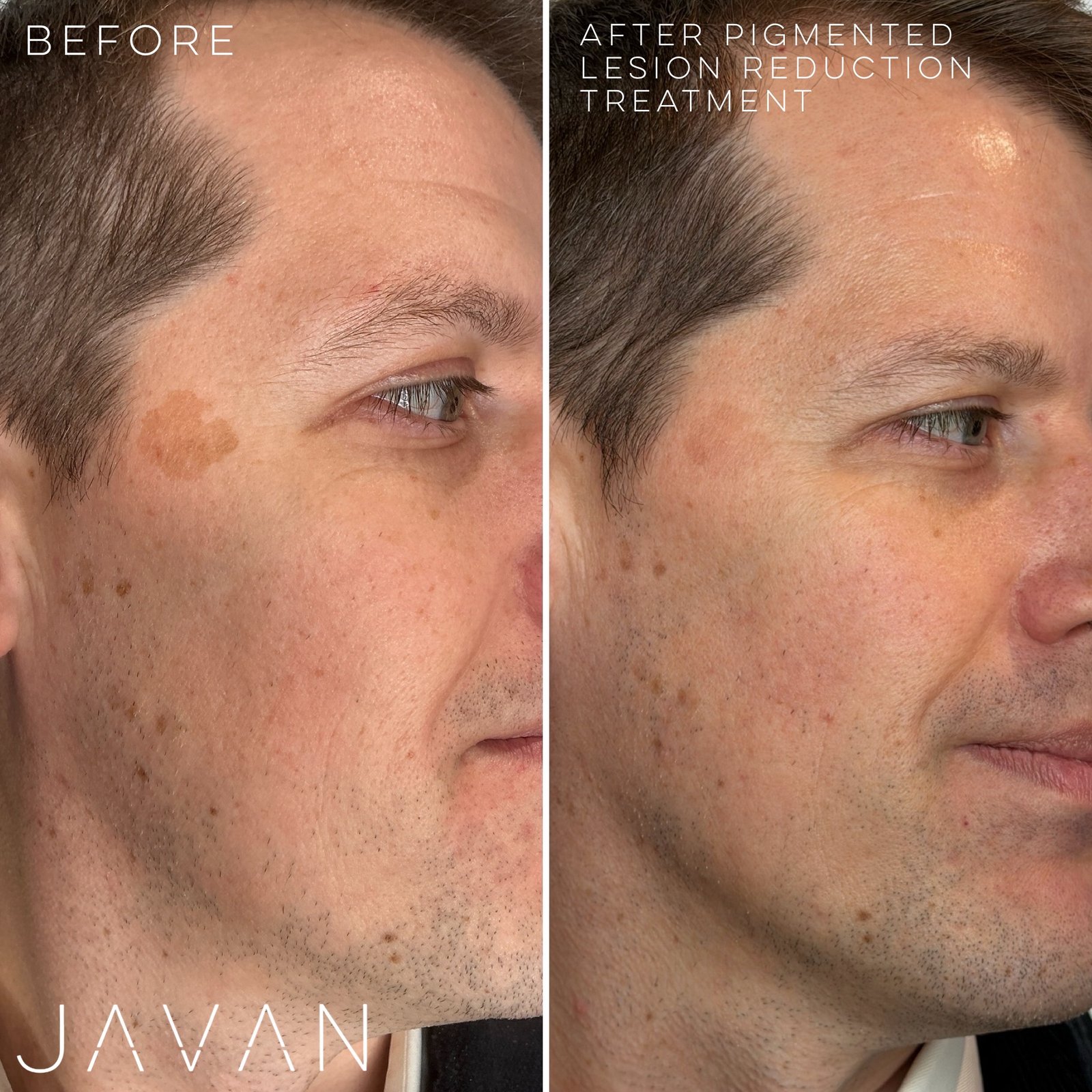 Laser Skin Rejuvenation