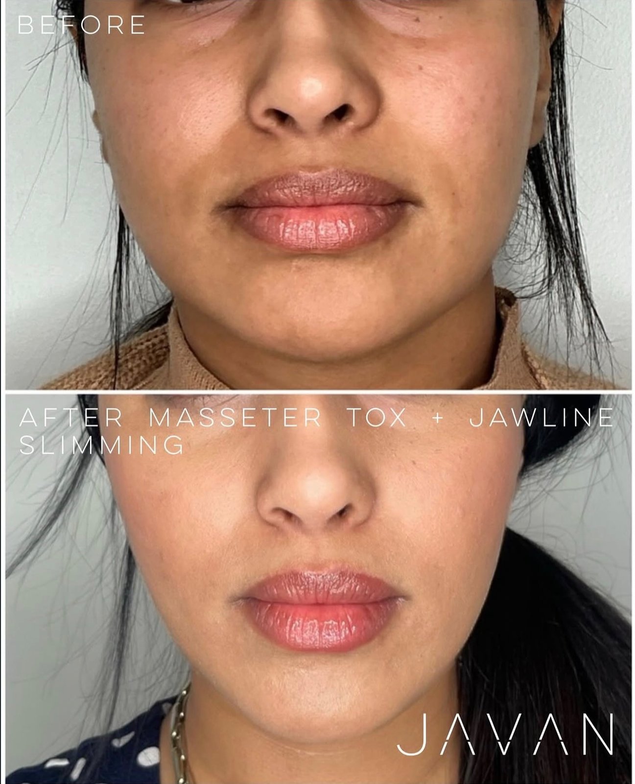Lip Flip / Microtox