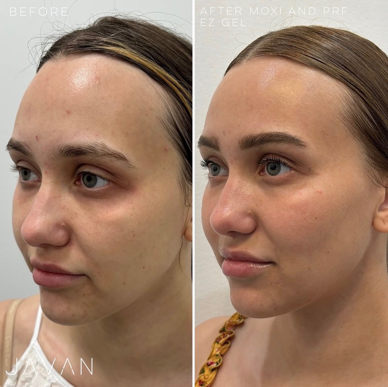 Liquid Gold Plasma Facial / PRF EZ Gel