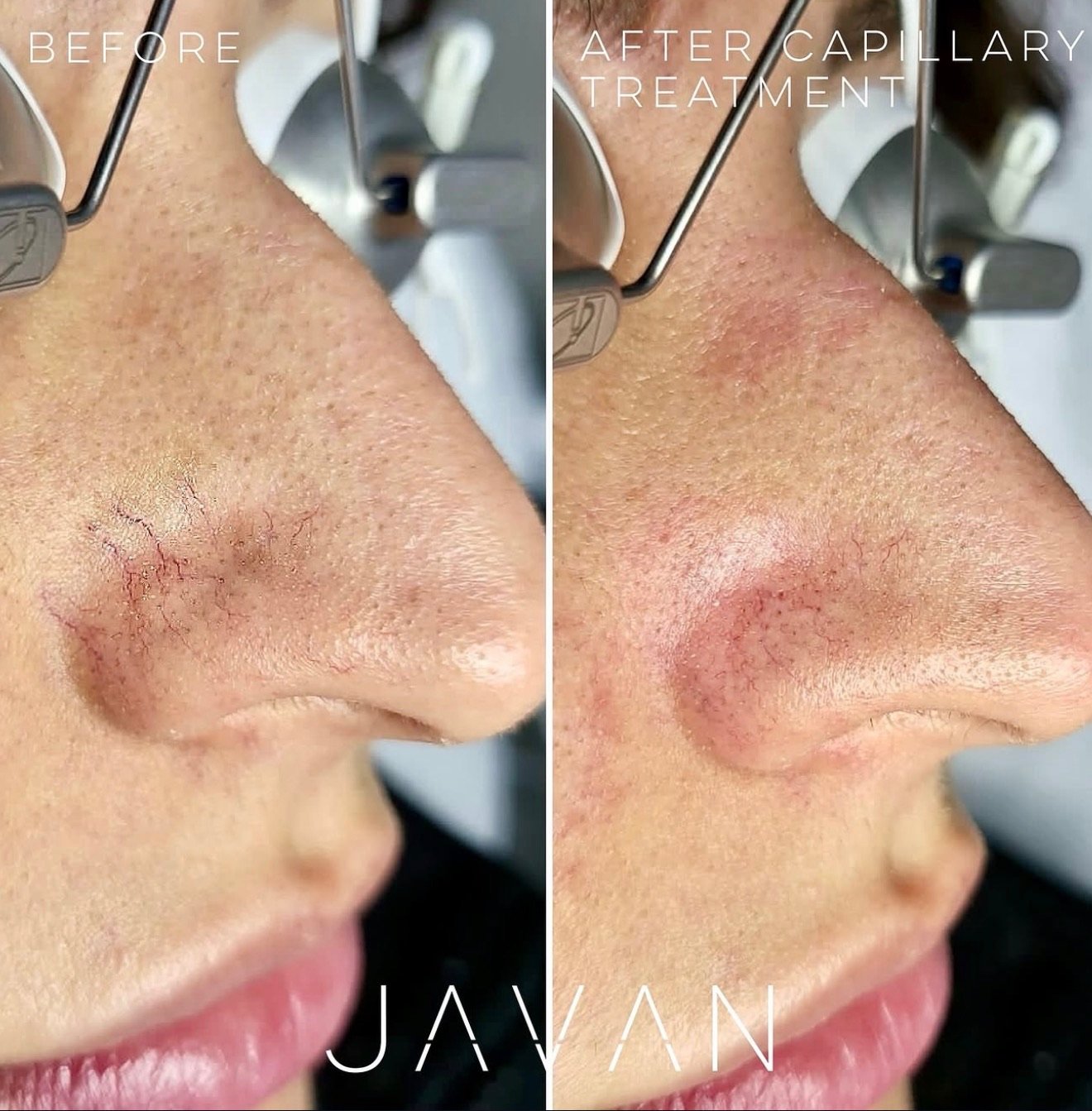 Vein Treatment
